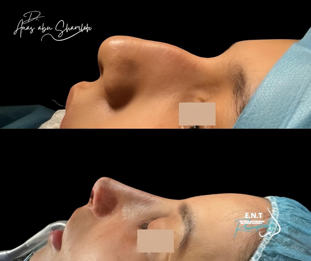 الدكتور أنس ابوشملة - أخصائي أنف و أذن و حنجرة و جراحة تجميل الأنف - Dr. Anas Abu Shamleh - Ear, Nose, Throat Specialist and Rhinoplasty Surgeon