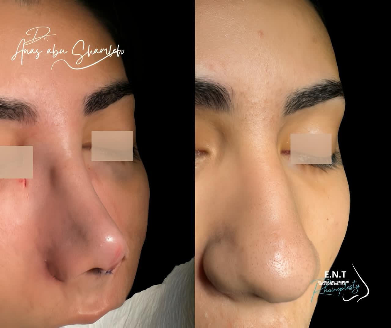 الدكتور أنس ابوشملة - أفضل دكتور انف واذن وجنجرة في الأردن - Dr. Anas Abu shamleh - Ear, Nose, Throat Specialist and Rhinoplasty Surgeon