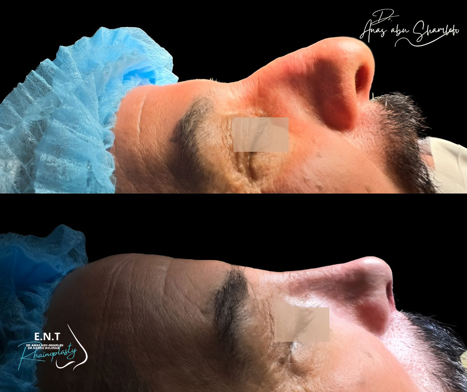 الدكتور أنس ابوشملة - أفضل دكتور انف واذن وجنجرة في الأردن - Dr. Anas Abu shamleh - Ear, Nose, Throat Specialist and Rhinoplasty Surgeon