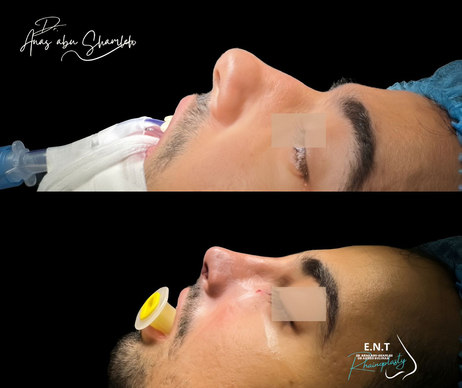 الدكتور أنس ابوشملة - أفضل دكتور انف واذن وجنجرة في الأردن - Dr. Anas Abu shamleh - Ear, Nose, Throat Specialist and Rhinoplasty Surgeon