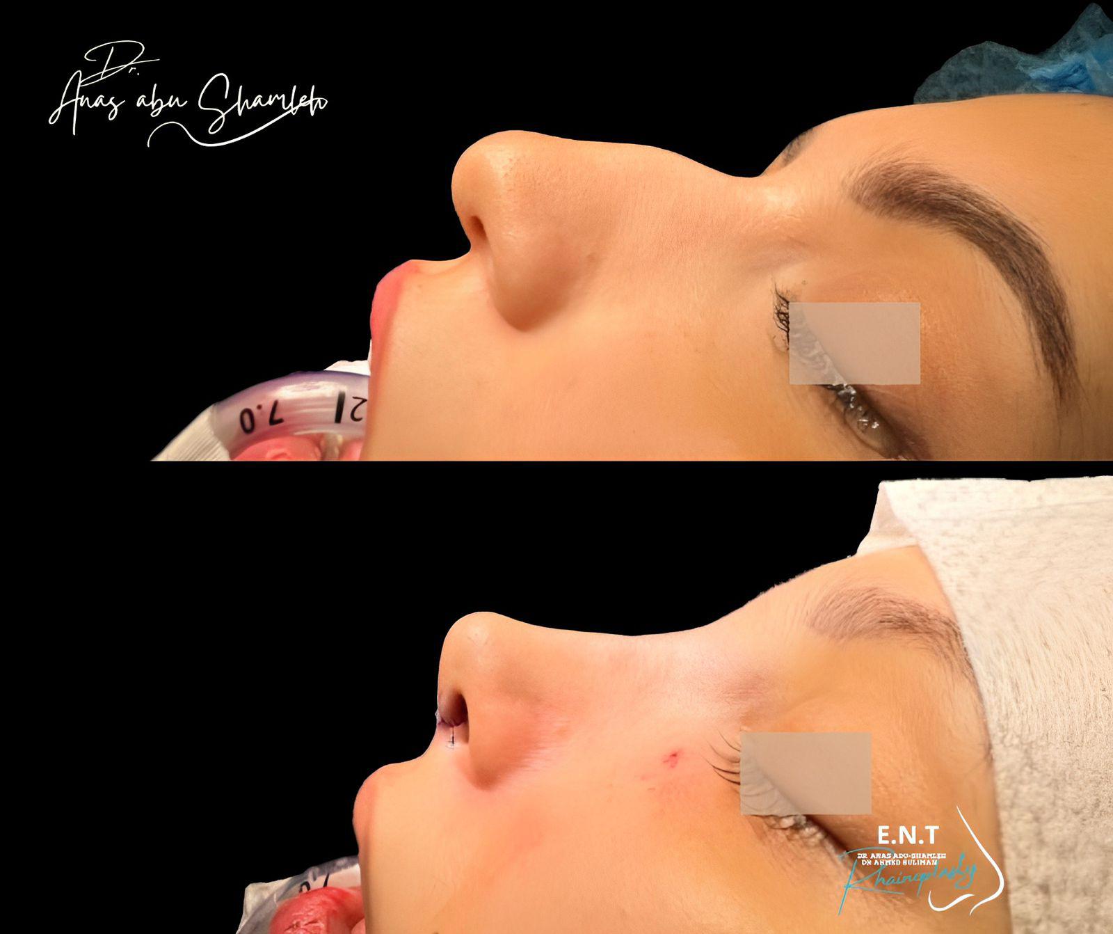 الدكتور أنس ابوشملة - أفضل دكتور انف واذن وجنجرة في الأردن - Dr. Anas Abu shamleh - Ear, Nose, Throat Specialist and Rhinoplasty Surgeon