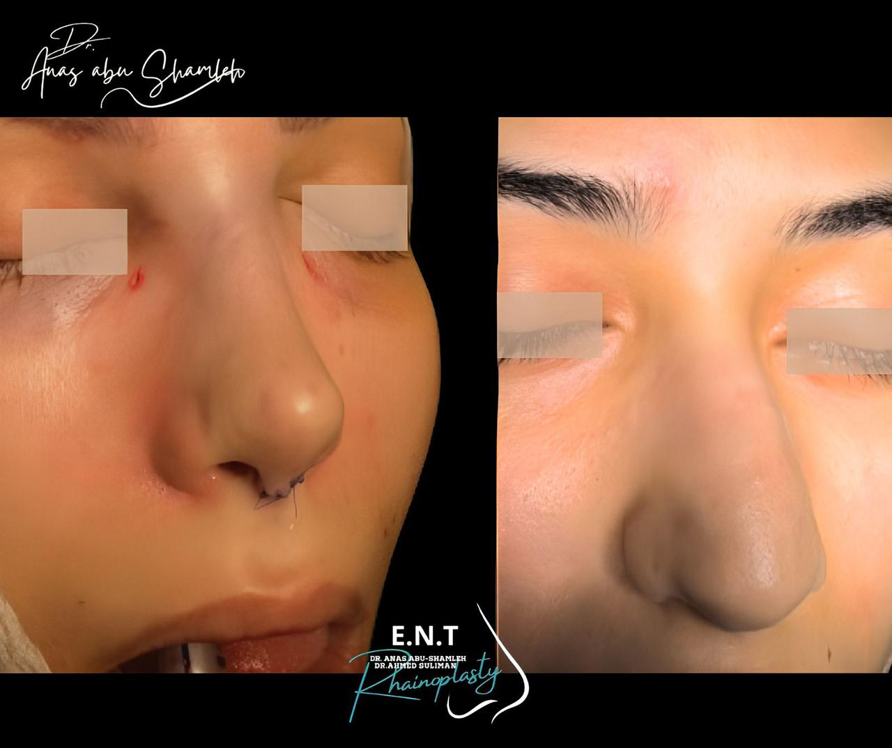 الدكتور أنس ابوشملة - أفضل دكتور تجميل أنف في الأردن - Dr. Anas Abu shamleh - Ear, Nose, Throat
Specialist and Rhinoplasty Surgeon
