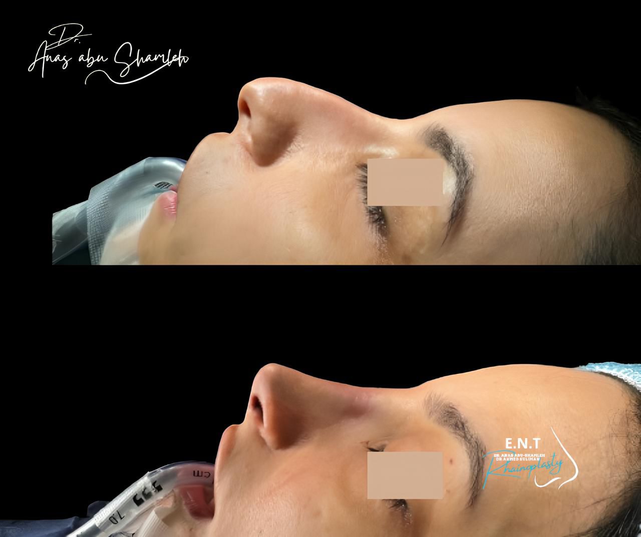 الدكتور أنس ابوشملة - أخصائي أنف و أذن و حنجرة و جراحة تجميل الأنف - Dr. Anas Abu shamleh - Ear, Nose, Throat Specialist and Rhinoplasty Surgeon