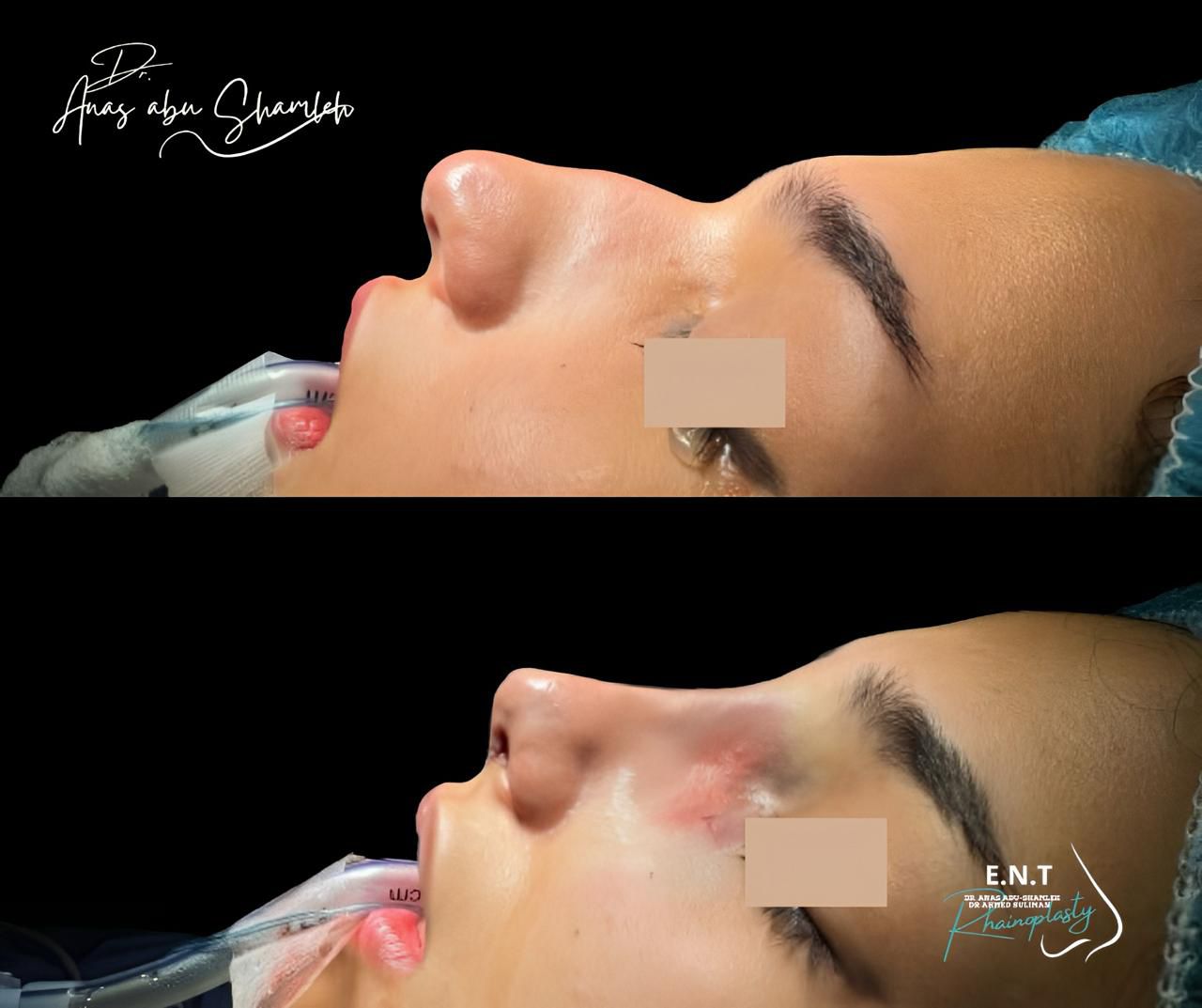 الدكتور أنس ابوشملة - أخصائي أنف و أذن و حنجرة و جراحة تجميل الأنف - Dr. Anas Abu shamleh - Ear, Nose, Throat Specialist and Rhinoplasty Surgeon