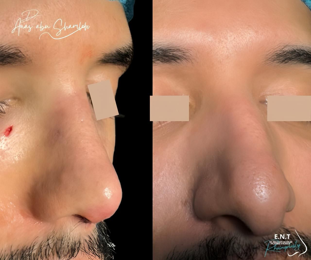 الدكتور أنس ابوشملة - أفضل دكتور أنف وأذن وجنجرة في الأردن - Dr. Anas Abu shamleh - Ear, Nose, Throat
Specialist and Rhinoplasty Surgeon
