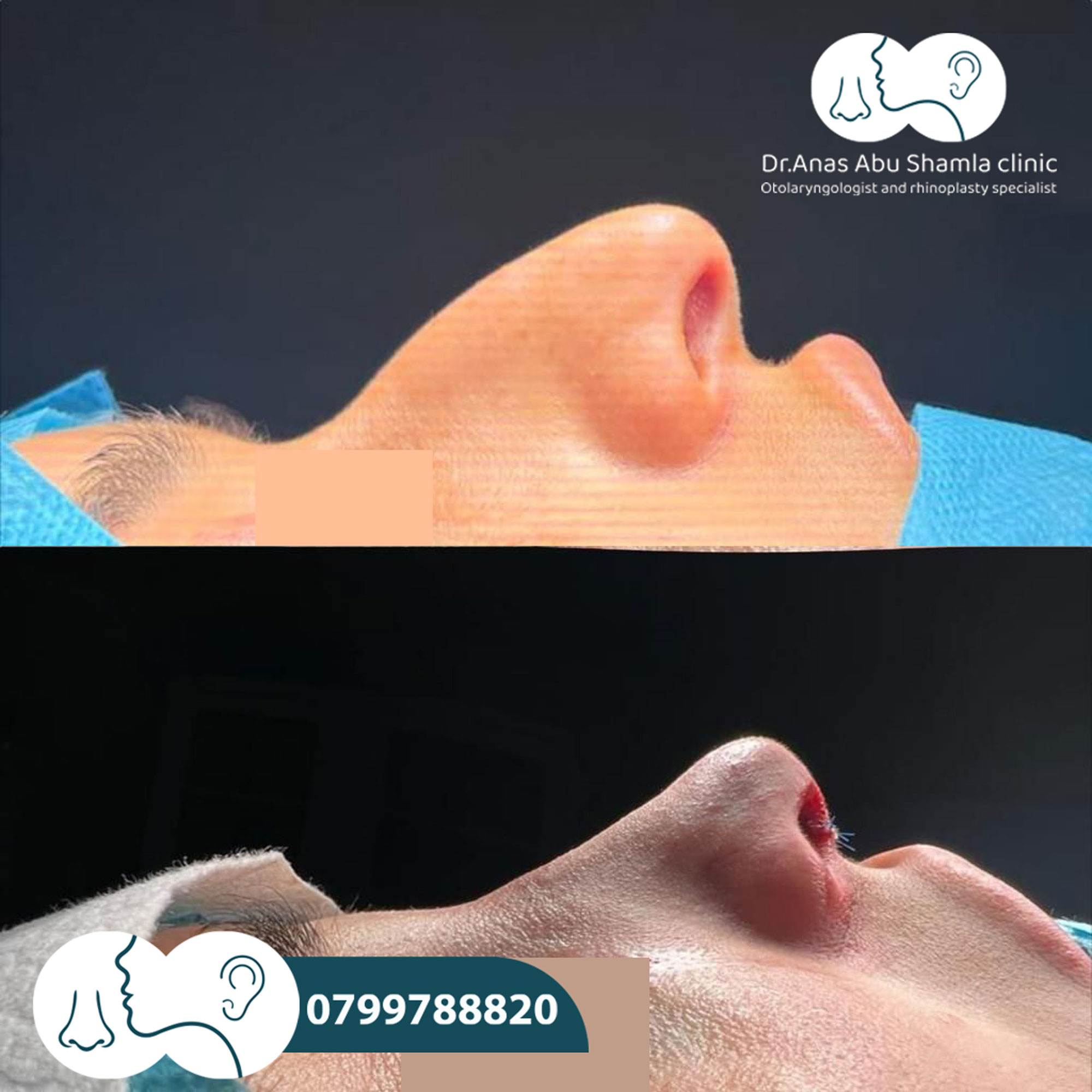 الدكتور أنس ابوشملة - أفضل دكتور أنف وأذن وجنجرة في الأردن - Dr. Anas Abu shamleh - Ear, Nose, Throat
Specialist and Rhinoplasty Surgeon
