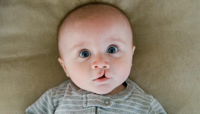 الشفة الارنبية