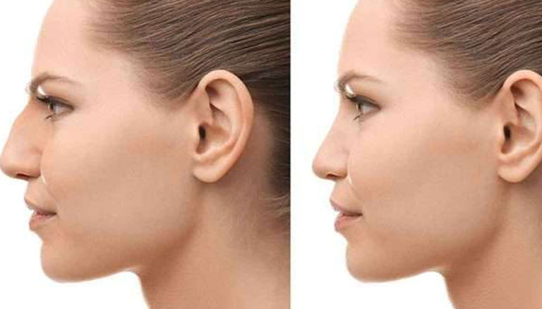 أنواع جراحات تجميل الأنف