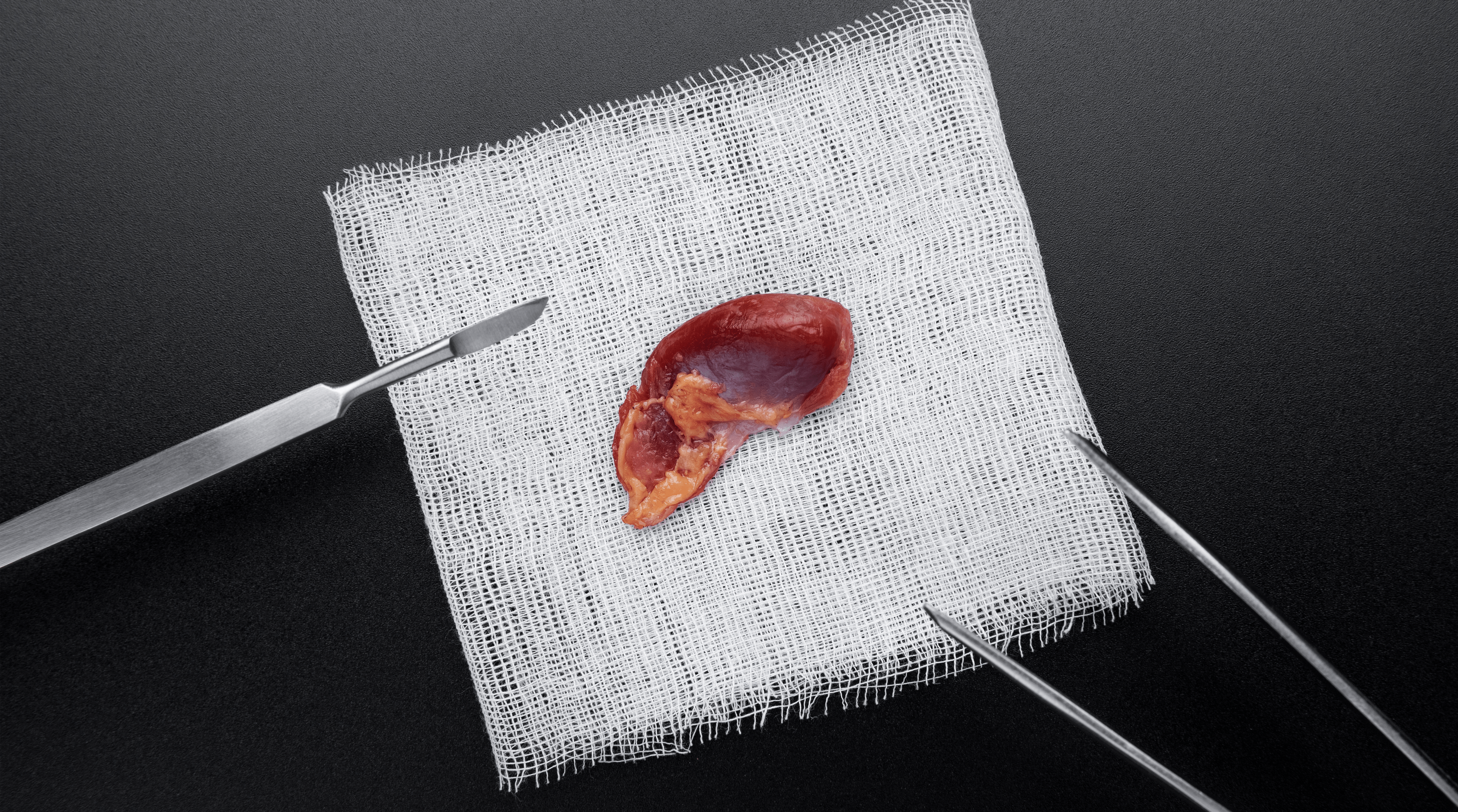 إزالة الزوائد اللحمية الأنفية في عمان | د. أنس أبو شملة - استشاري الأنف والأذن والحنجرة وجراح تجميل الأنف